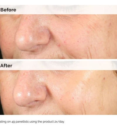 the ordinary alpha arbutin results before after picture