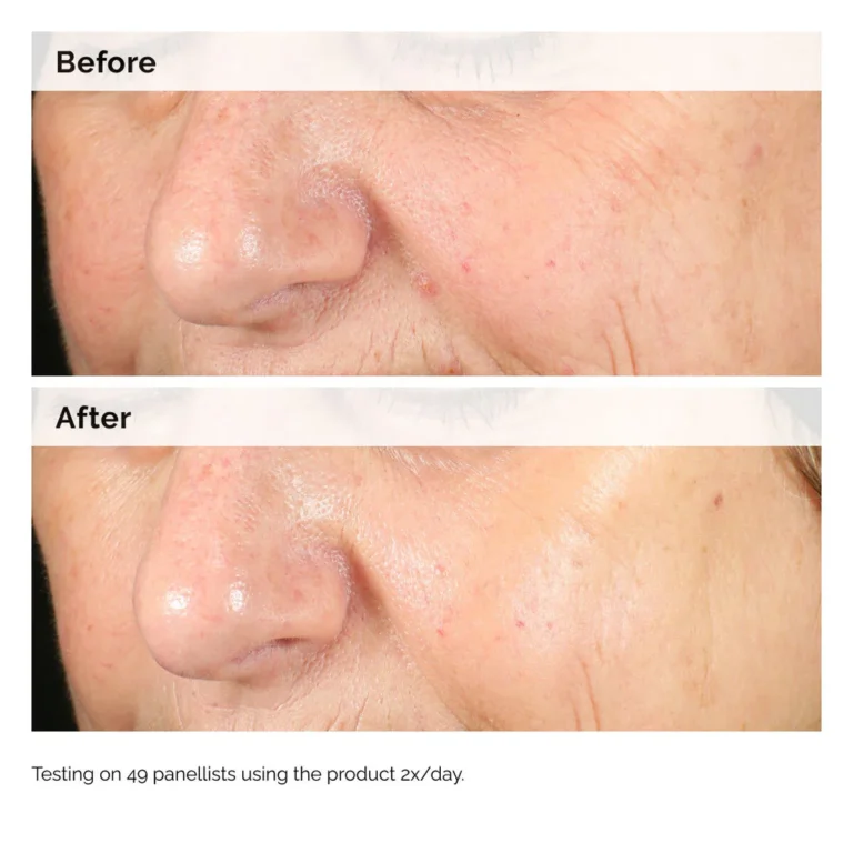 the ordinary alpha arbutin results before after picture