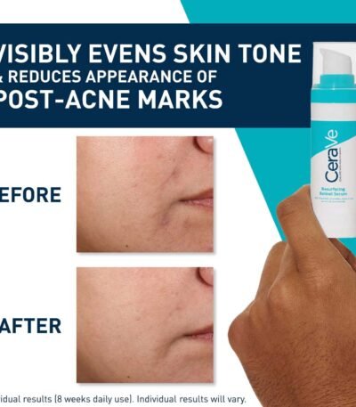 CeraVe Resurfacing Retinol Serum Before & After Picture