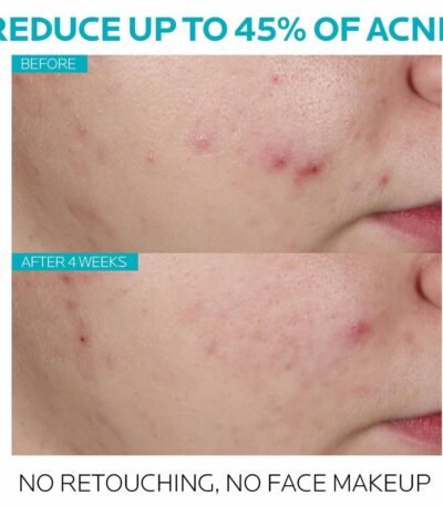 La Roche Posay Serum Results