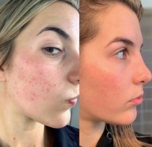 The Ordinary Retinol Serum