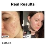 Cosrx Niacinamide Serum Results Before & After
