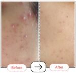 Accufix Niacinamide Serum Results