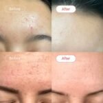 Accufix Salicylic Acid Serum Results