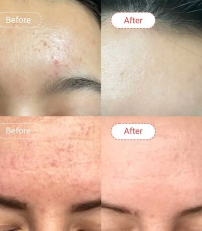 Accufix Salicylic Acid Serum Results