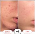Accufix Vitamin C Serum Before & After Results