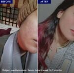 Jenpharm Mandelac Serum Results