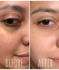 before and after dark circles solution results