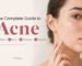 Acne Full Guide: Causes, Types, Treatments, and Prevention