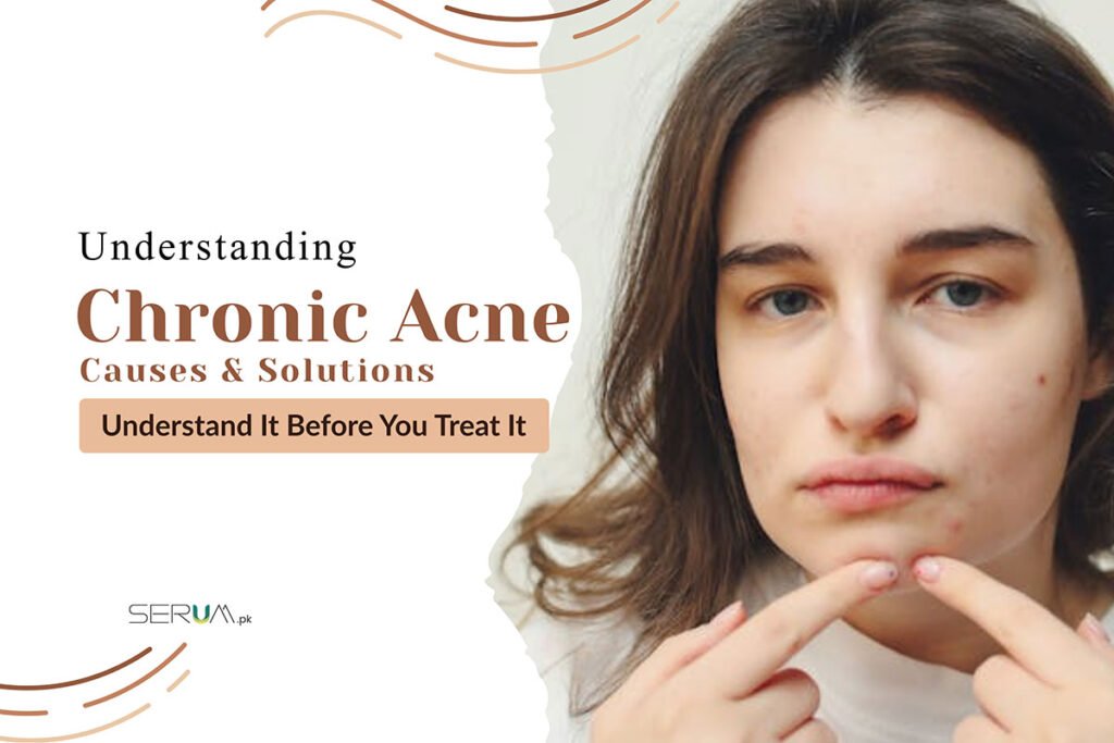Learn Why Acne Come Back Again